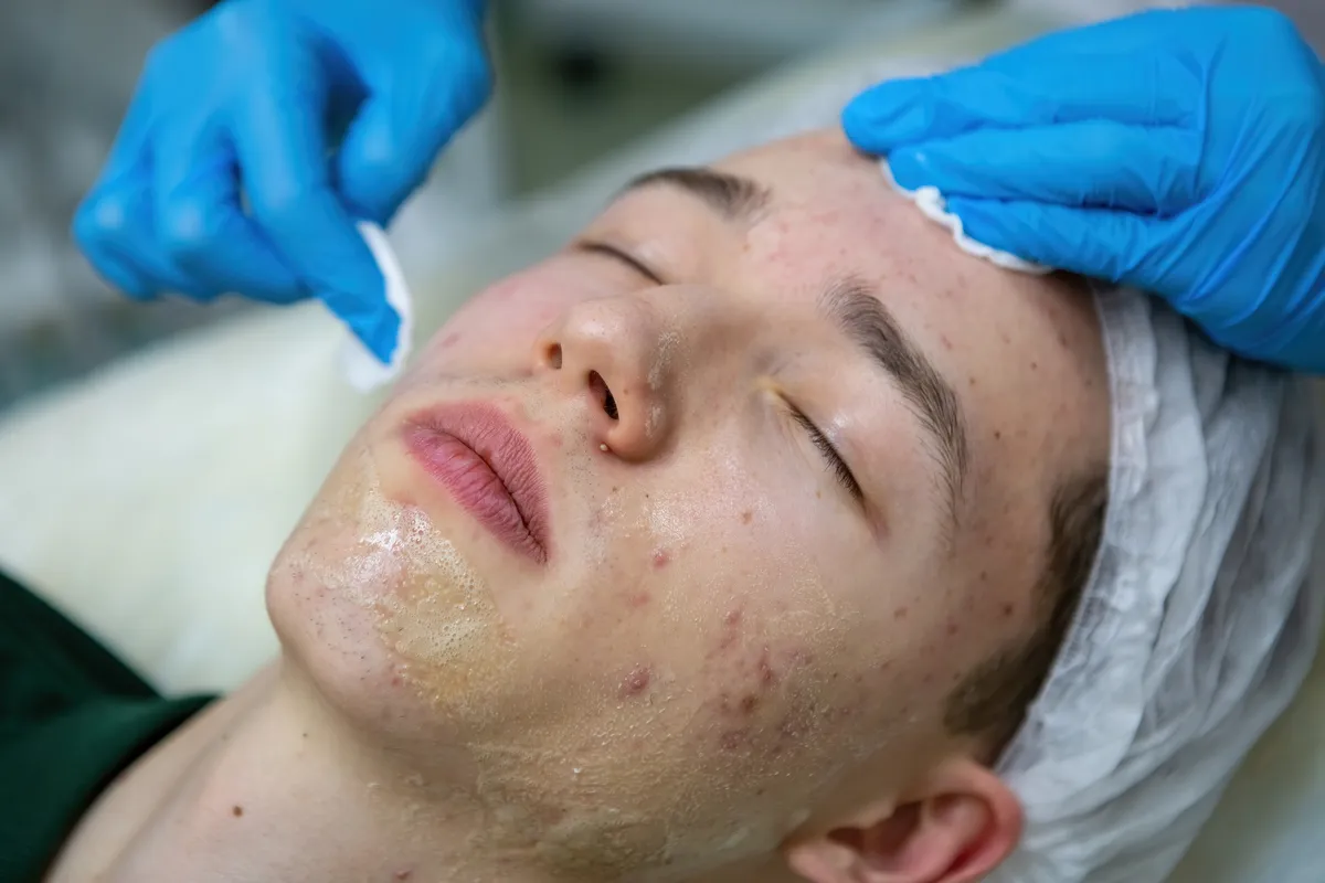 acne-treatment-in-a-teenager-2023-11-27-05-25-20-utc
